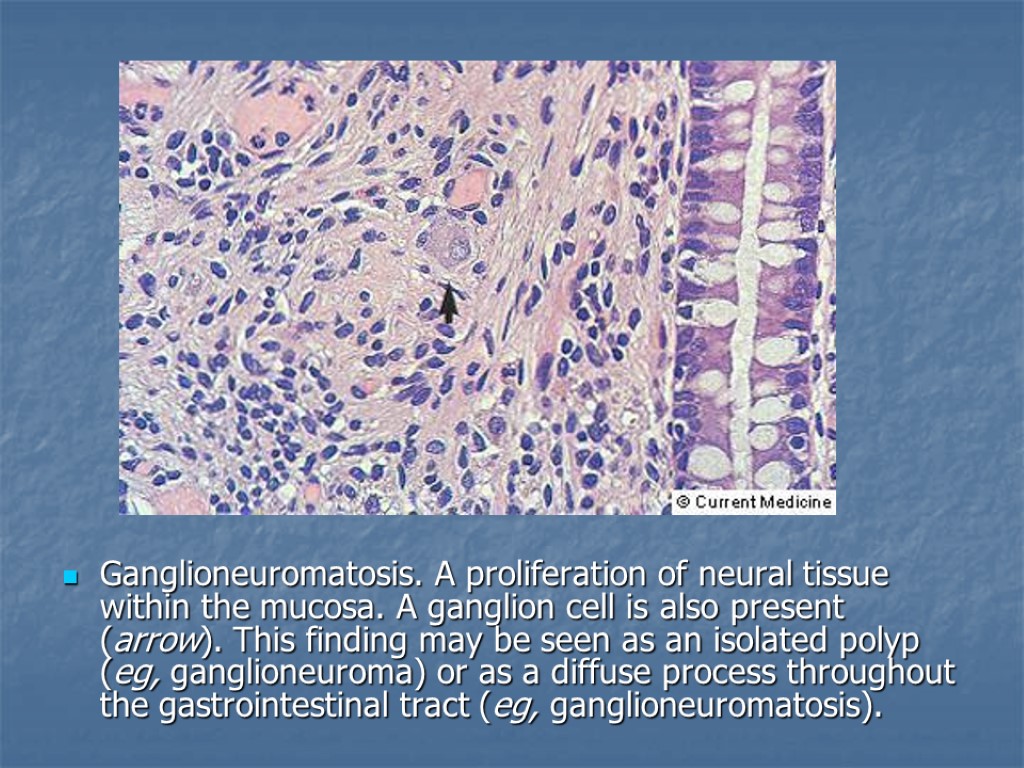 Ganglioneuromatosis. A proliferation of neural tissue within the mucosa. A ganglion cell is also